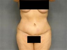 Body Contouring After Photo by Ellen Janetzke, MD; Bloomfield Hills, MI - Case 25793