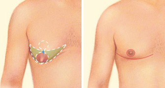 male breast reduction