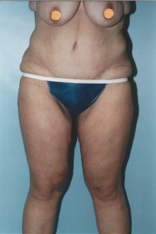 Tummy Tuck After Photo by Kristoffer Ning Chang, MD; San Francisco, CA - Case 10358