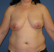 Breast Reconstruction Before Photo by Neal Goldberg, MD; Scarsdale, NY - Case 10490