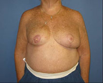 Breast Reconstruction After Photo by Neal Goldberg, MD; Scarsdale, NY - Case 10491