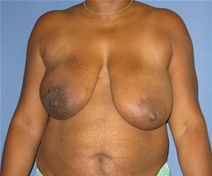 Breast Reconstruction Before Photo by Neal Goldberg, MD; Scarsdale, NY - Case 20724