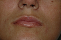 Dermal Fillers Before Photo by Lucie Capek, MD; Cohoes, NY - Case 21500