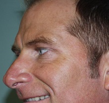 Botulinum Toxin After Photo by Richard Greco, MD; Savannah, GA - Case 2160