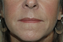 Dermal Fillers After Photo by Lucie Capek, MD; Cohoes, NY - Case 21650