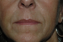 Dermal Fillers Before Photo by Lucie Capek, MD; Cohoes, NY - Case 21650