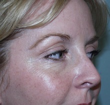 Botulinum Toxin After Photo by Richard Greco, MD; Savannah, GA - Case 2167