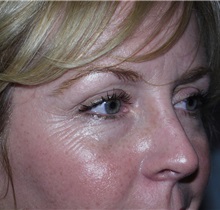 Botulinum Toxin Before Photo by Richard Greco, MD; Savannah, GA - Case 2167