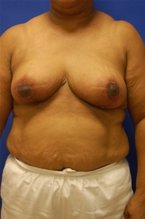 Breast Reduction After Photo by Randy Proffitt, MD; Mobile, AL - Case 21834