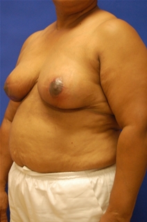 Breast Reduction After Photo by Randy Proffitt, MD; Mobile, AL - Case 21834