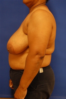 Breast Reduction Before Photo by Randy Proffitt, MD; Mobile, AL - Case 21834