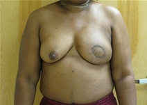 Breast Reconstruction After Photo by Neal Goldberg, MD; Scarsdale, NY - Case 21980