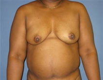 Breast Reconstruction Before Photo by Neal Goldberg, MD; Scarsdale, NY - Case 21980