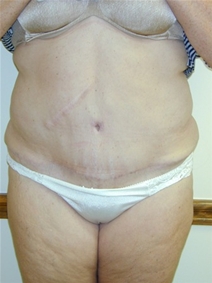 Liposuction After Photo by Randy Proffitt, MD; Mobile, AL - Case 22013