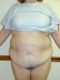 Liposuction Before Photo by Randy Proffitt, MD; Mobile, AL - Case 22013