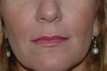 Dermal Fillers After Photo by Lucie Capek, MD; Cohoes, NY - Case 22203