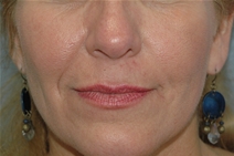 Dermal Fillers Before Photo by Lucie Capek, MD; Cohoes, NY - Case 22203