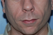 Dermal Fillers After Photo by Lucie Capek, MD; Cohoes, NY - Case 22416