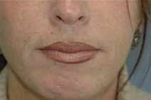 Dermal Fillers After Photo by Lucie Capek, MD; Cohoes, NY - Case 22420