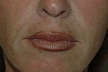 Dermal Fillers Before Photo by Lucie Capek, MD; Cohoes, NY - Case 22420