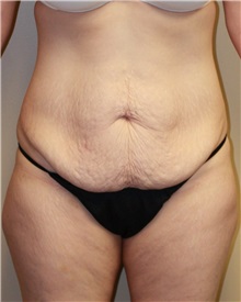 Tummy Tuck Before Photo by Meegan Gruber, MD; Tampa, FL - Case 22471