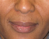 Dermal Fillers Before Photo by Neal Goldberg, MD; Scarsdale, NY - Case 22486