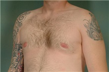 Male Breast Reduction After Photo by Robert Zubowski, MD; Paramus, NJ - Case 23731