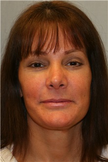 Facelift After Photo by Meegan Gruber, MD; Tampa, FL - Case 23892