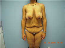 Body Contouring Before Photo by Florence Mussat, MD; Chicago, IL - Case 24745