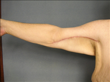 Arm Lift After Photo by Ellen Janetzke, MD; Bloomfield Hills, MI - Case 25137