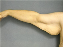 Arm Lift Before Photo by Ellen Janetzke, MD; Bloomfield Hills, MI - Case 25137