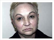 Facelift Before Photo by David Abramson, MD; Englewood, NJ - Case 25307