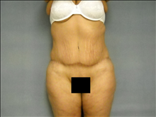 Body Contouring After Photo by Ellen Janetzke, MD; Bloomfield Hills, MI - Case 25507