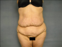 Body Contouring Before Photo by Ellen Janetzke, MD; Bloomfield Hills, MI - Case 25507