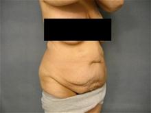 Body Contouring Before Photo by Ellen Janetzke, MD; Bloomfield Hills, MI - Case 25793