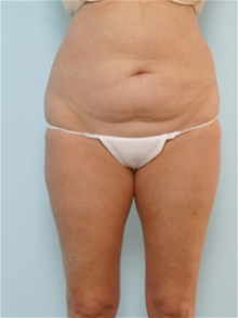 Body Contouring Before Photo by Paul Vitenas, Jr., MD; Houston, TX - Case 25990