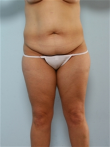 Body Contouring Before Photo by Paul Vitenas, Jr., MD; Houston, TX - Case 25992