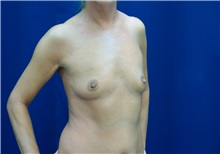 Breast Augmentation Before Photo by Ricardo Rodriguez, MD; Lutherville-Timonium, MD - Case 27004