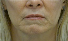 Dermal Fillers After Photo by Ricardo Rodriguez, MD; Lutherville-Timonium, MD - Case 27032