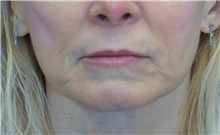 Dermal Fillers Before Photo by Ricardo Rodriguez, MD; Lutherville-Timonium, MD - Case 27032