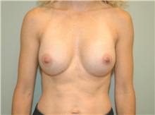 Breast Augmentation After Photo by Elisa Burgess, MD; Lake Oswego, OR - Case 27301