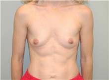 Breast Augmentation Before Photo by Elisa Burgess, MD; Lake Oswego, OR - Case 27301