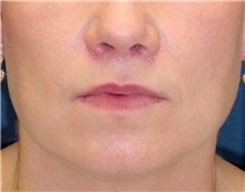 Dermal Fillers After Photo by Ricardo Rodriguez, MD; Lutherville-Timonium, MD - Case 27316