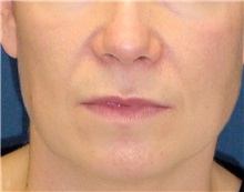 Dermal Fillers Before Photo by Ricardo Rodriguez, MD; Lutherville-Timonium, MD - Case 27316