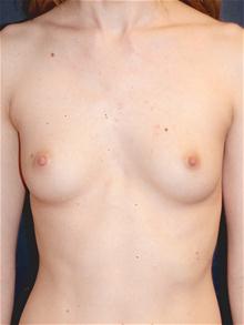 Breast Augmentation Before Photo by Michael Eisemann, MD; Houston, TX - Case 27425