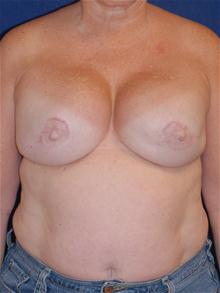 Breast Reconstruction After Photo by Michael Eisemann, MD; Houston, TX - Case 27442