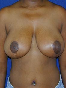 Breast Reduction After Photo by Michael Eisemann, MD; Houston, TX - Case 27449