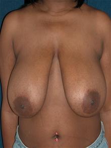 Breast Reduction Before Photo by Michael Eisemann, MD; Houston, TX - Case 27449