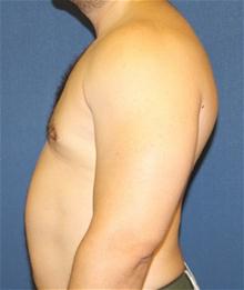 Male Breast Reduction After Photo by Laurence Glickman, MD, MSc, FRCS(c),  FACS; Garden City, NY - Case 27991