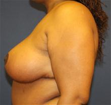 Breast Reduction After Photo by Laurence Glickman, MD, MSc, FRCS(c),  FACS; Garden City, NY - Case 28000